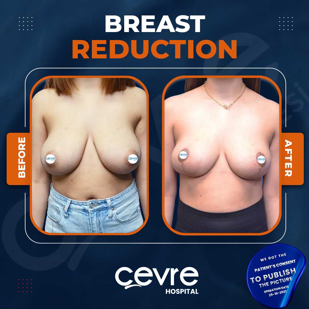 Breast Reduction