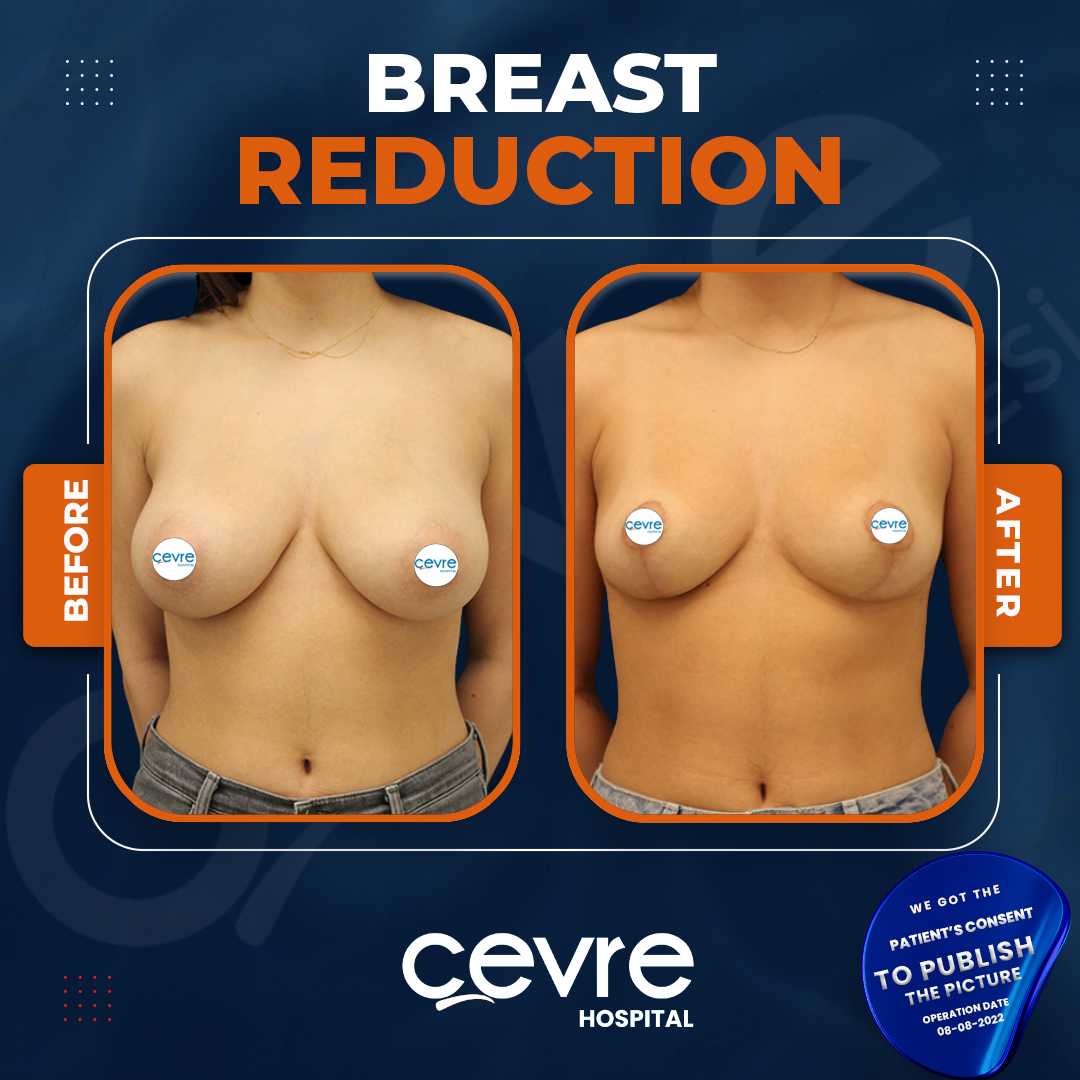 Breast Reduction