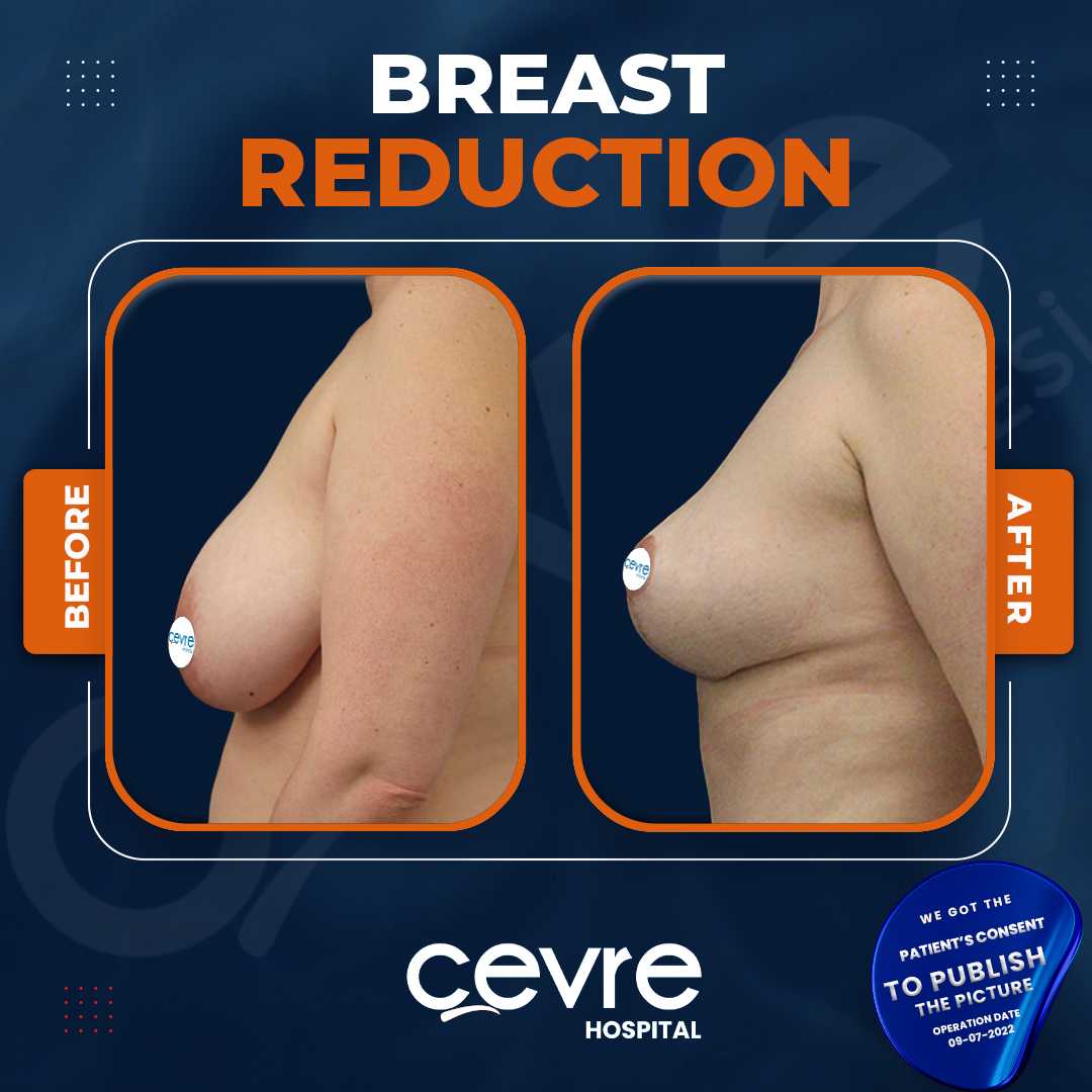Breast Reduction