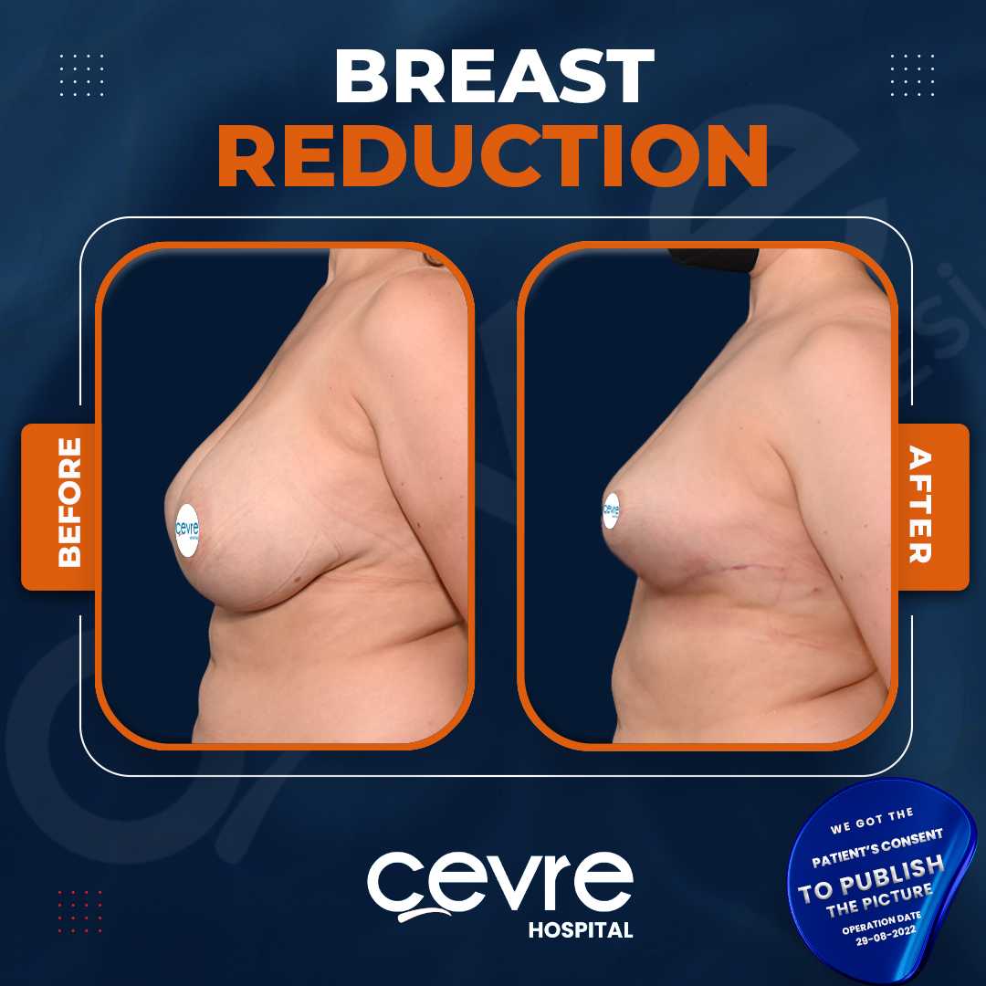 Breast Reduction