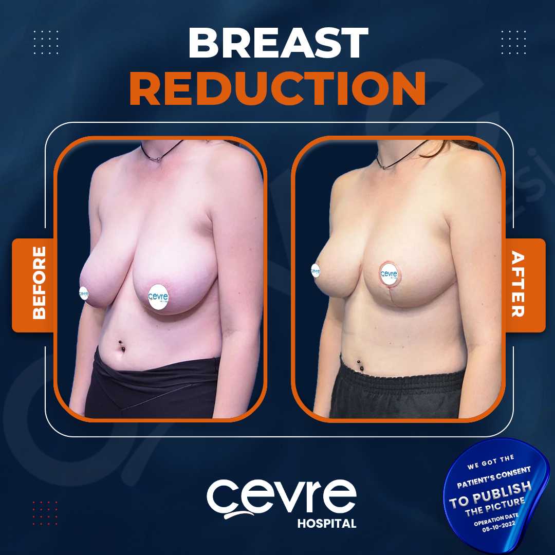 Breast Reduction