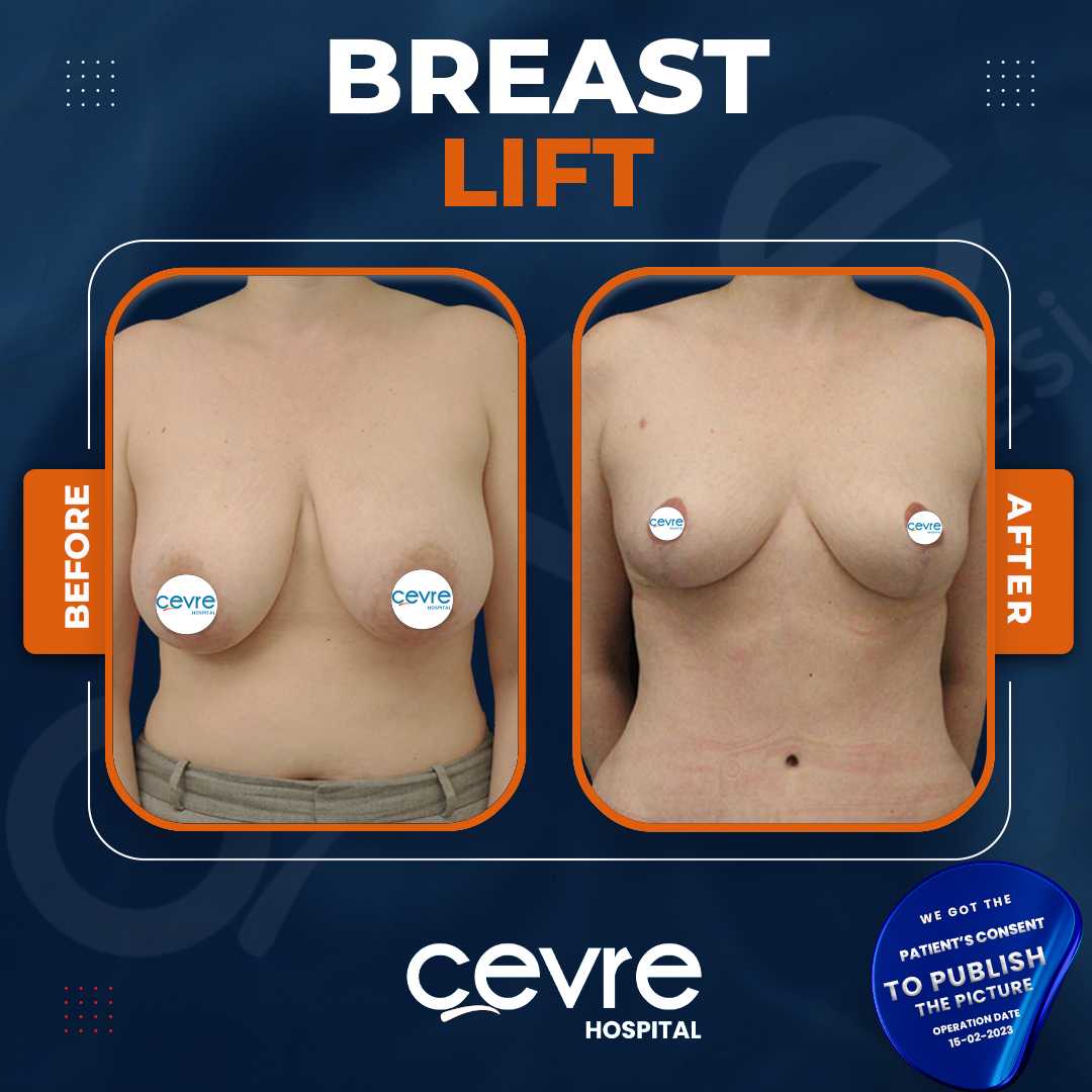 Breast Lift