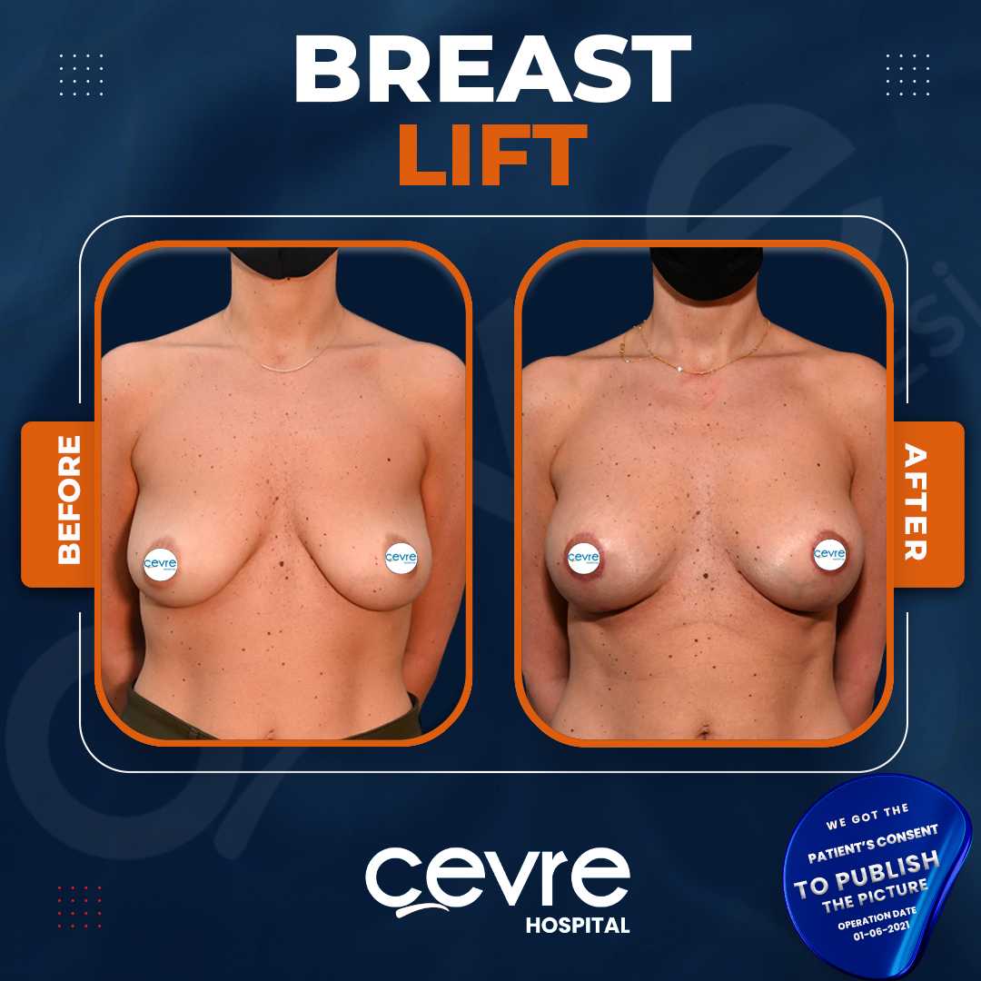Breast Lift