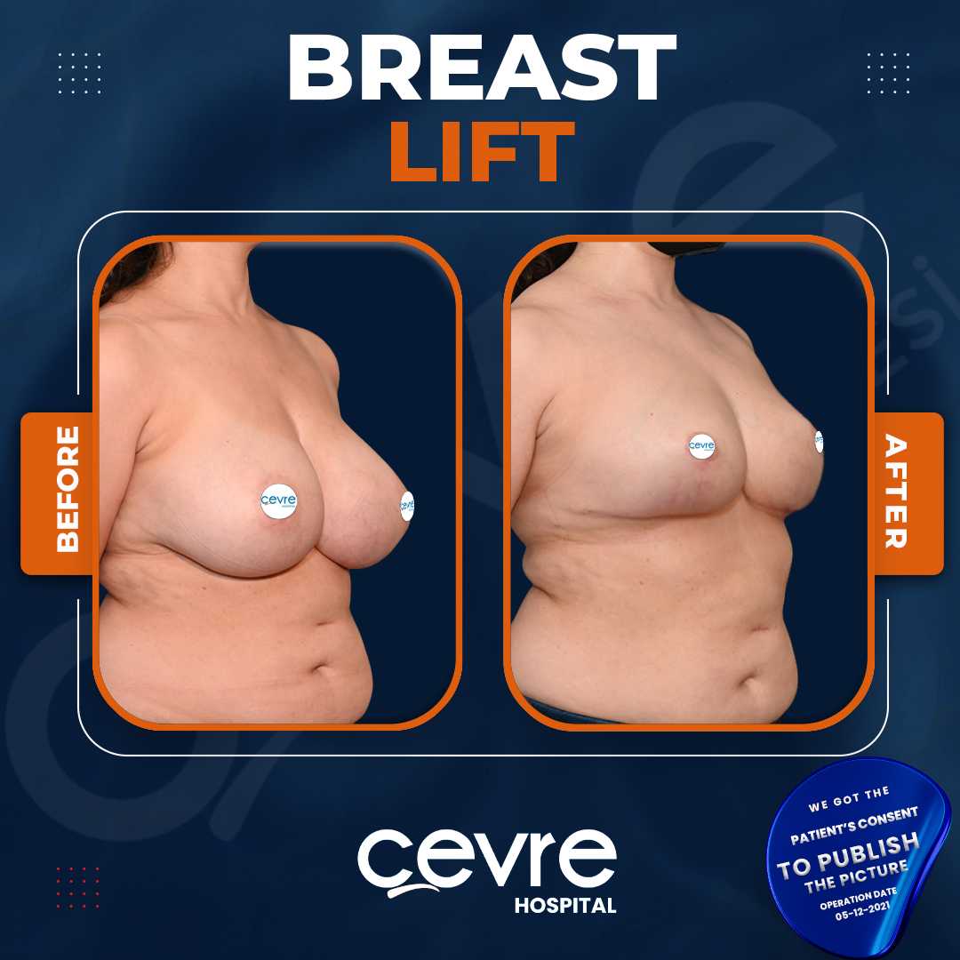 breast lift before after picture istanbul turkey