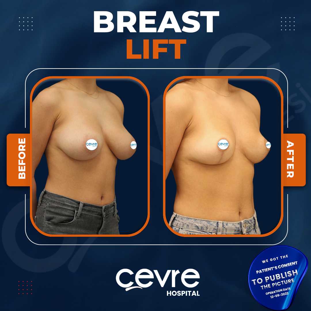 breast lift before after istanbul turkey