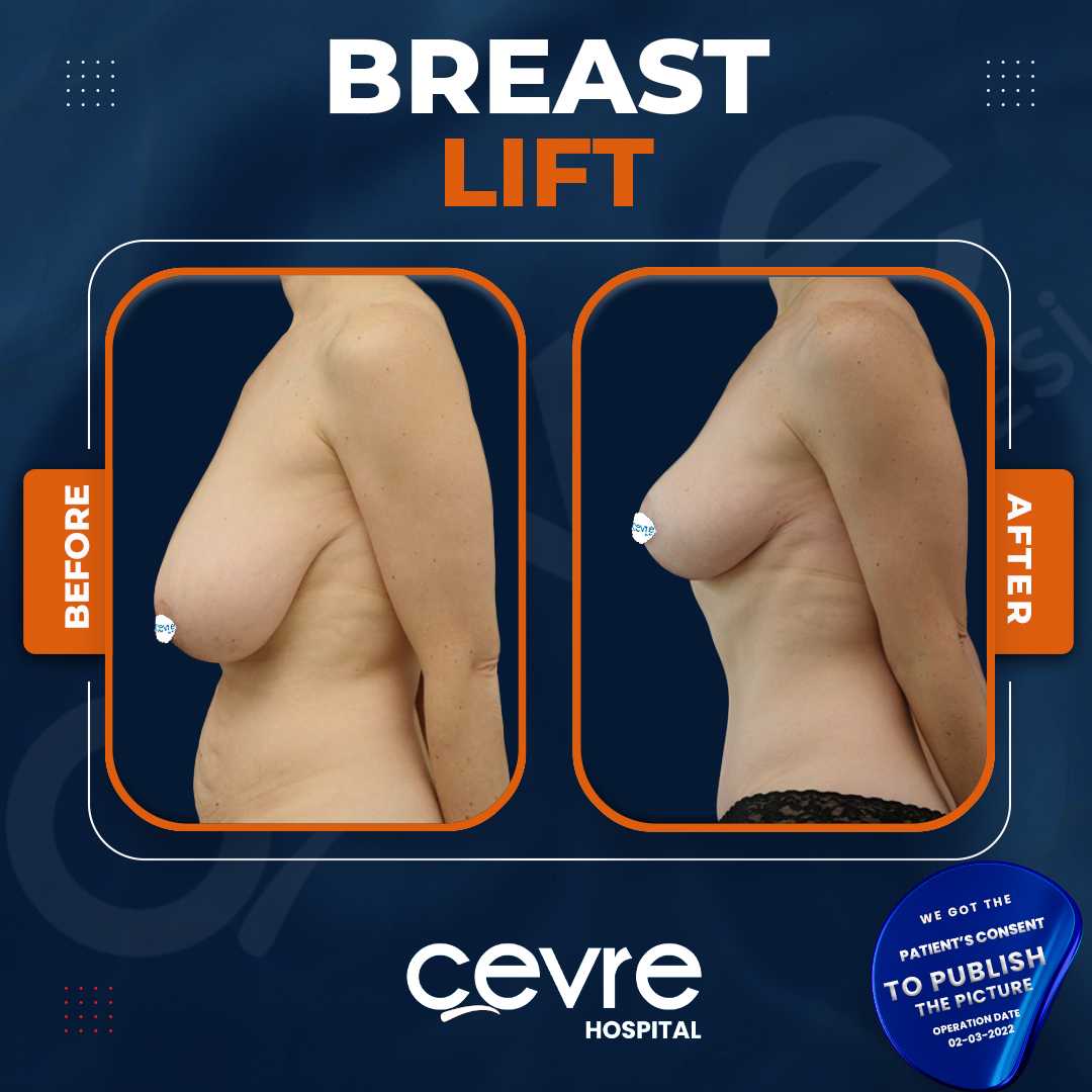 Breast Lift