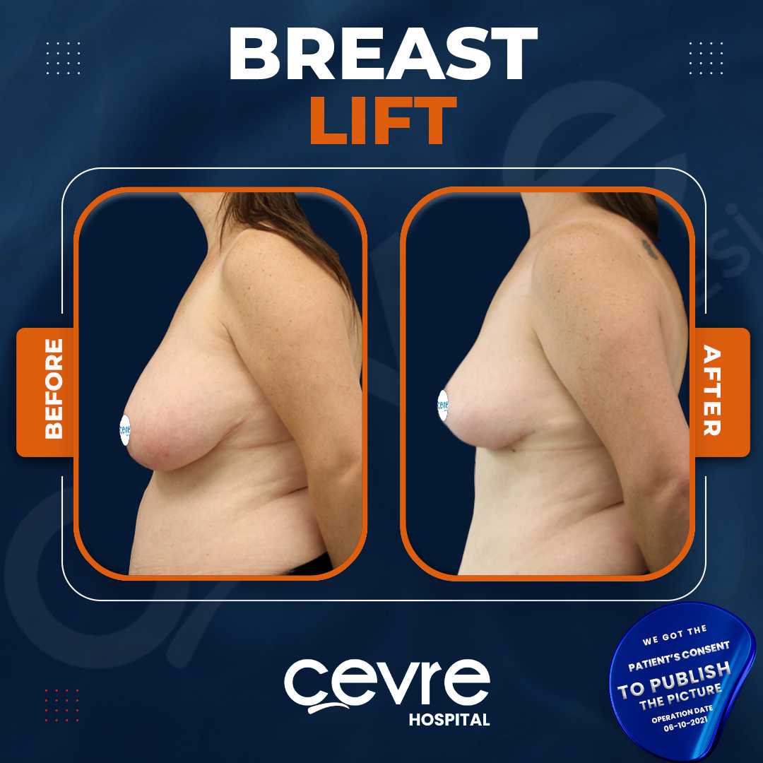 Breast Lift