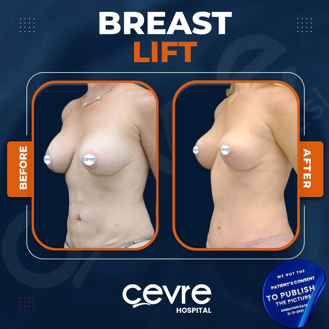 Breast Lift