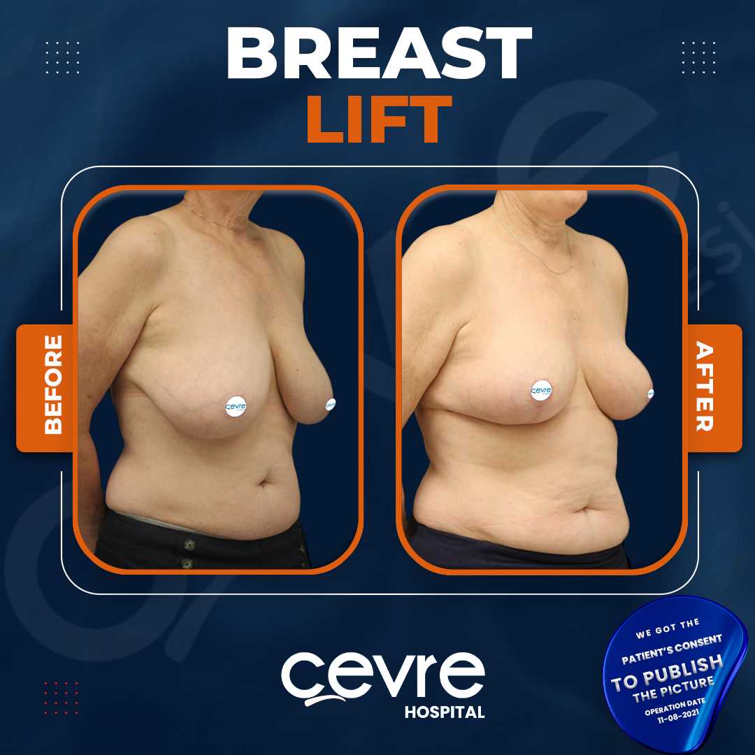 Breast Lift