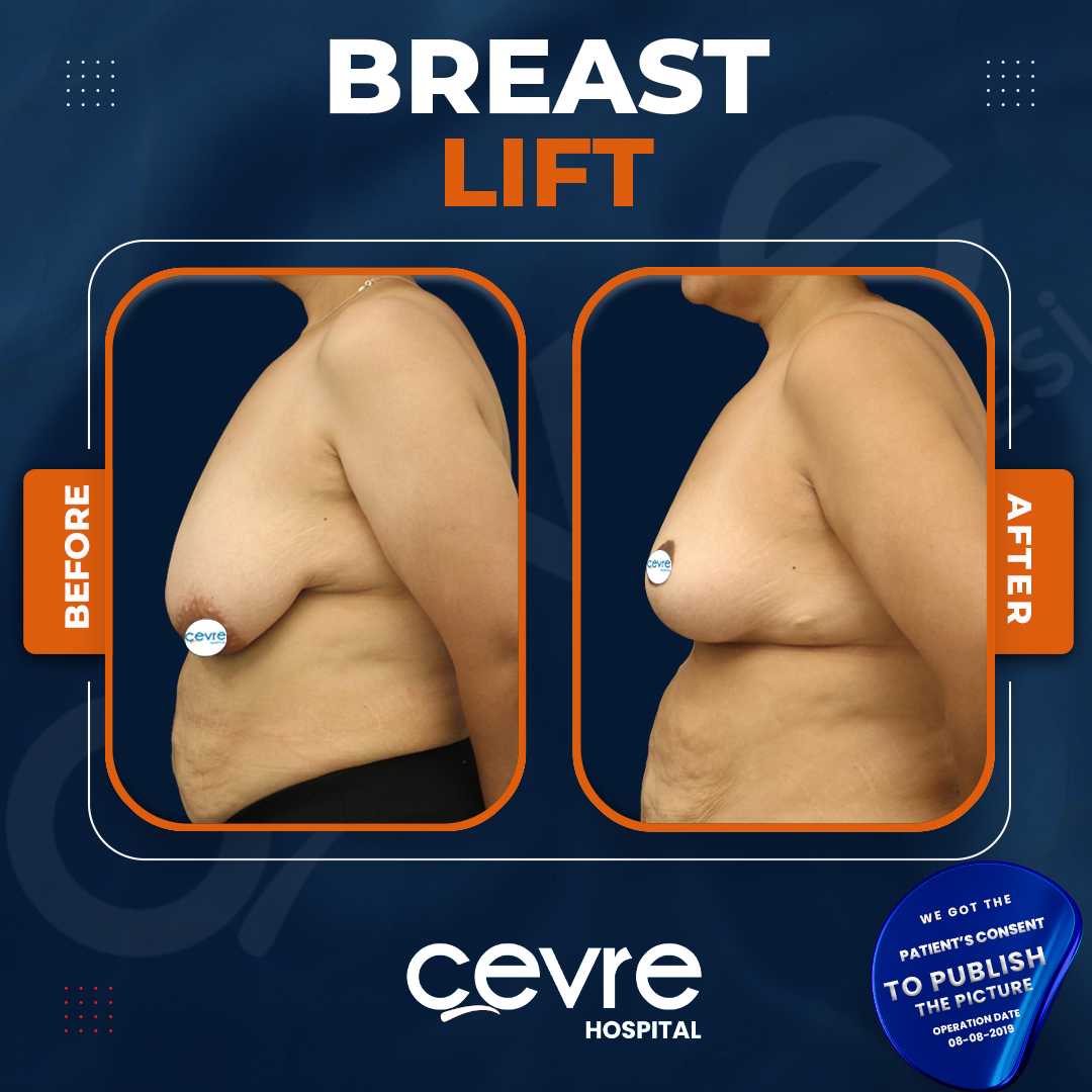 Breast Lift
