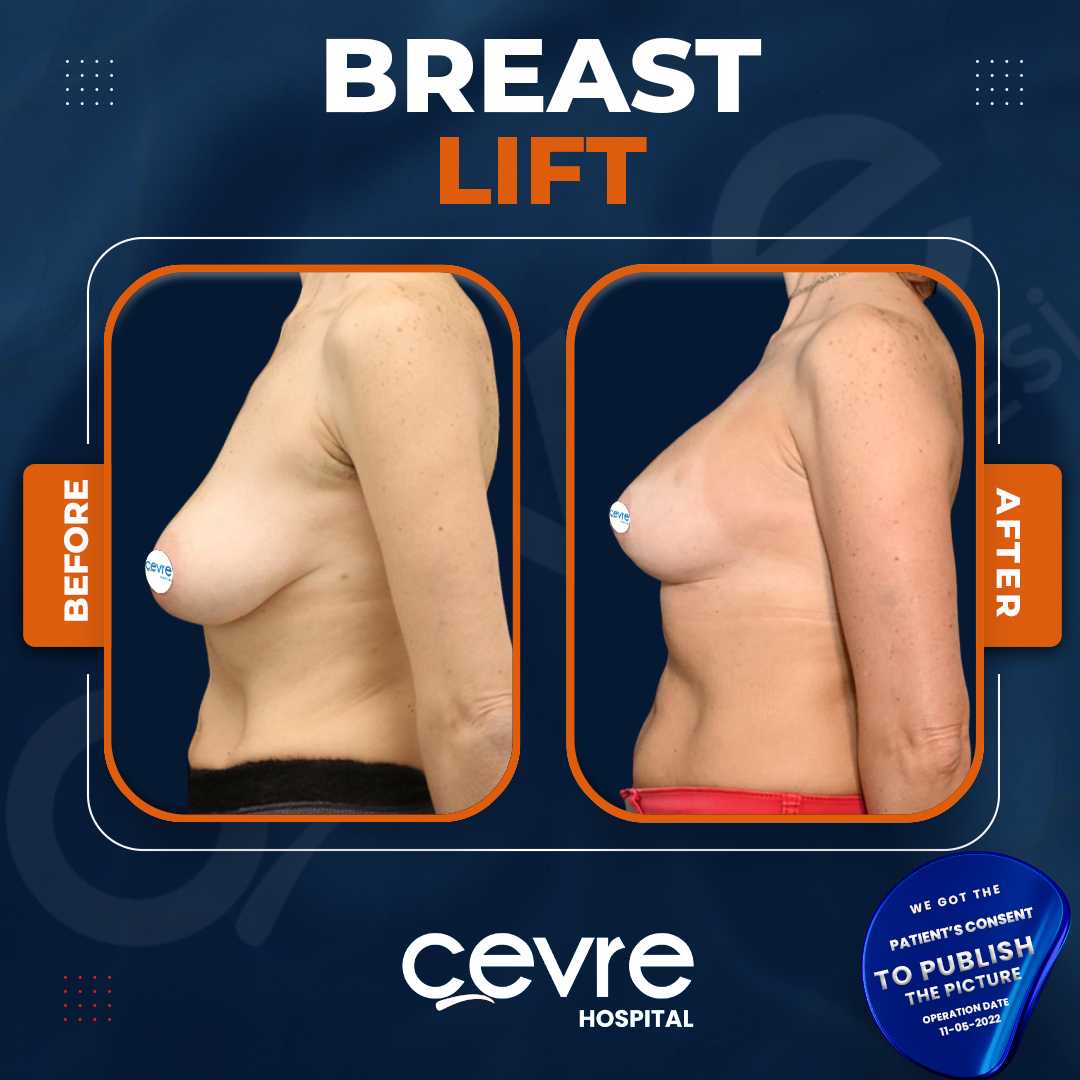 Breast Lift