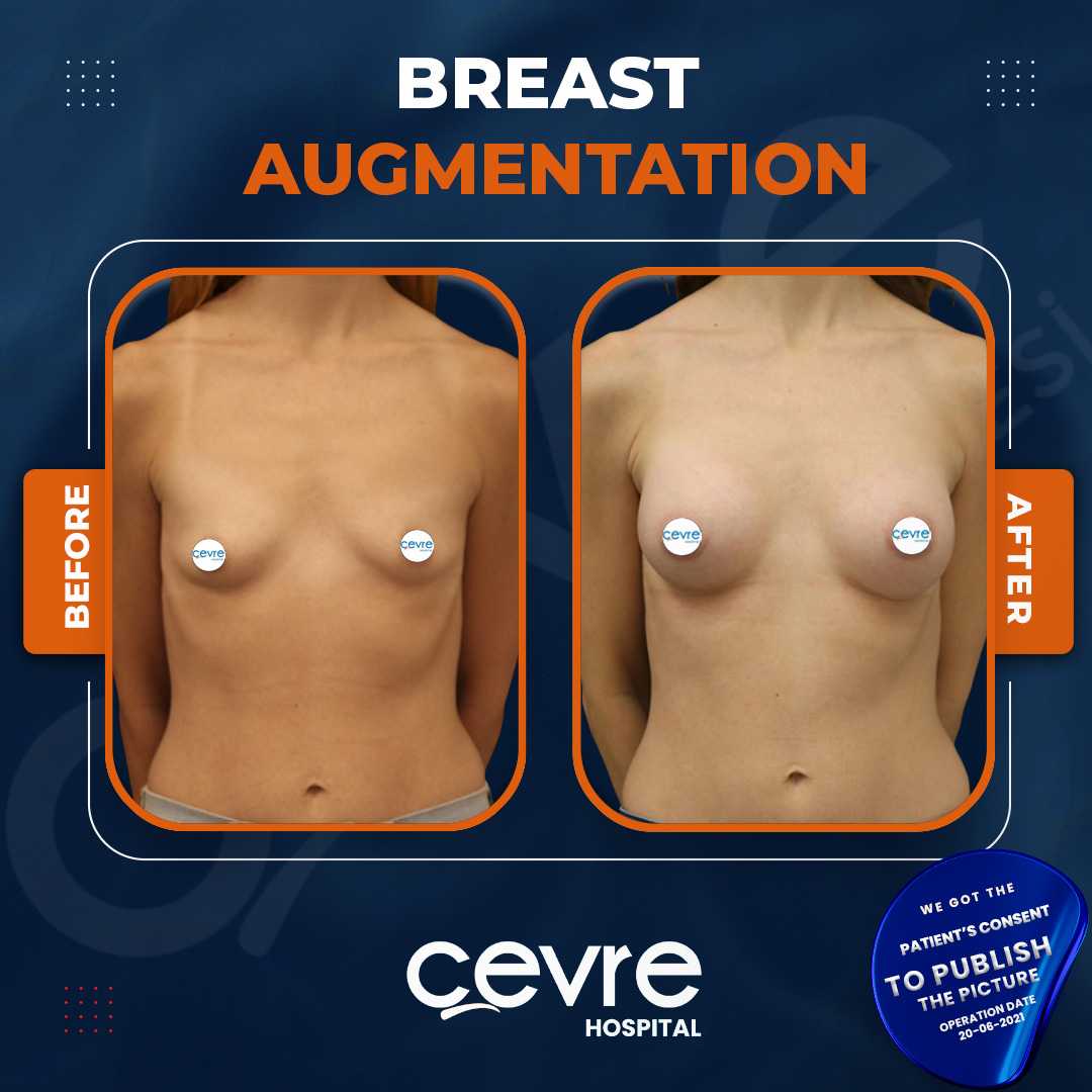 Breast Augmentation