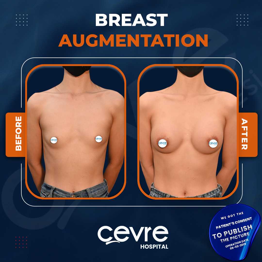 Breast Augmentation