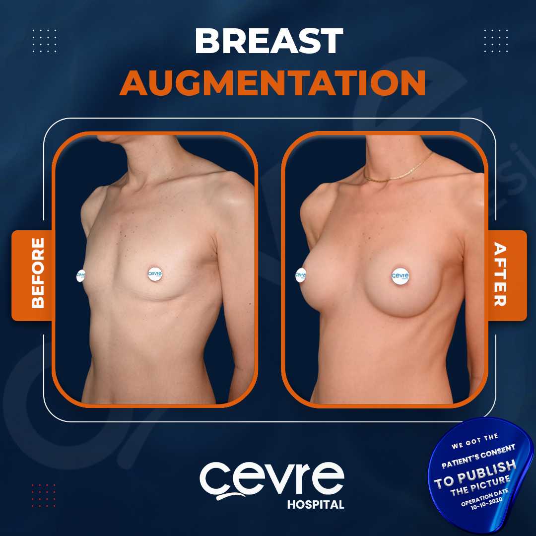 Breast Augmentation