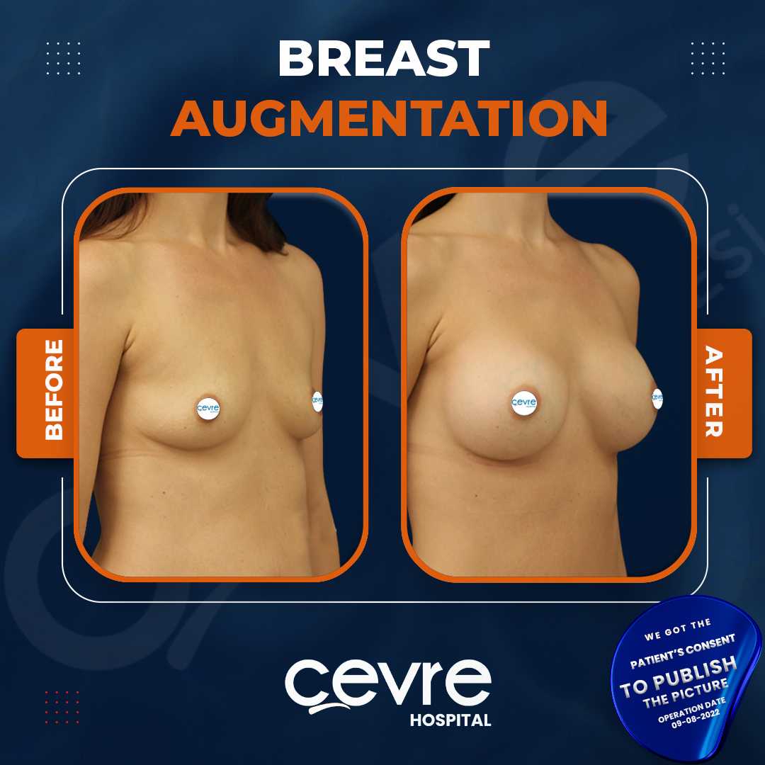 Breast Augmentation