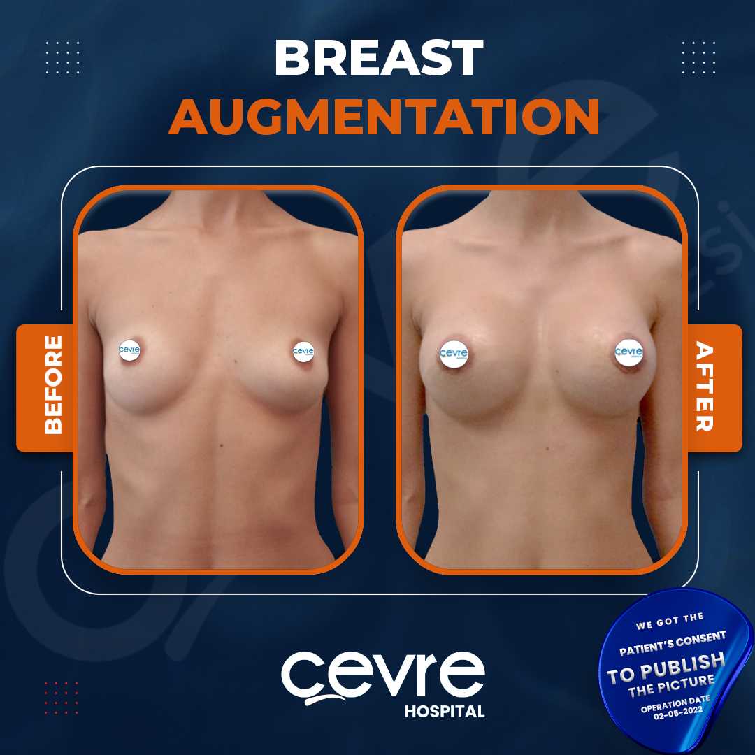Breast Augmentation