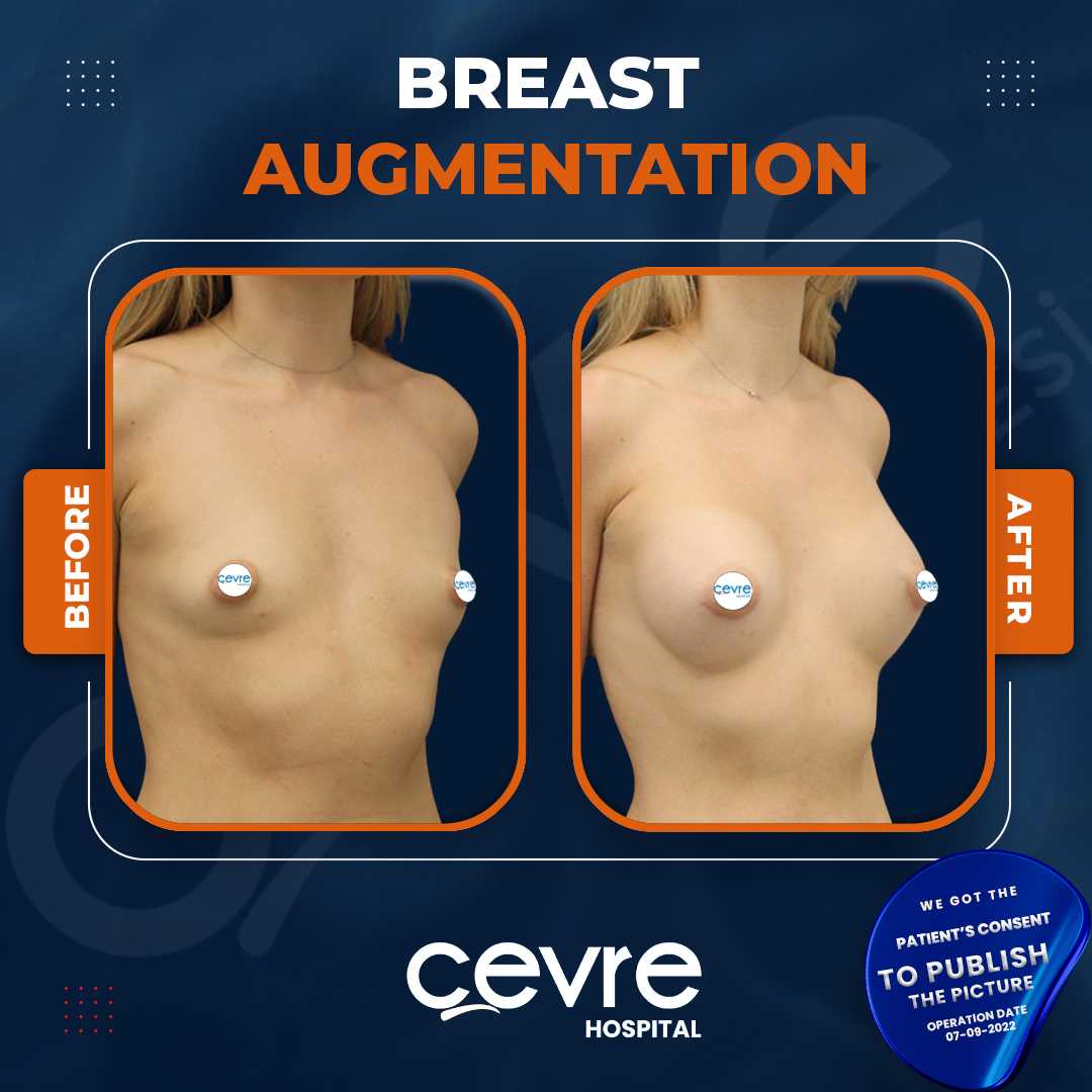 Breast Augmentation