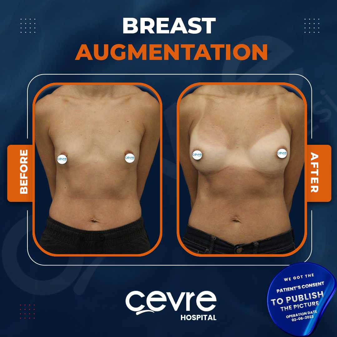 Breast Augmentation
