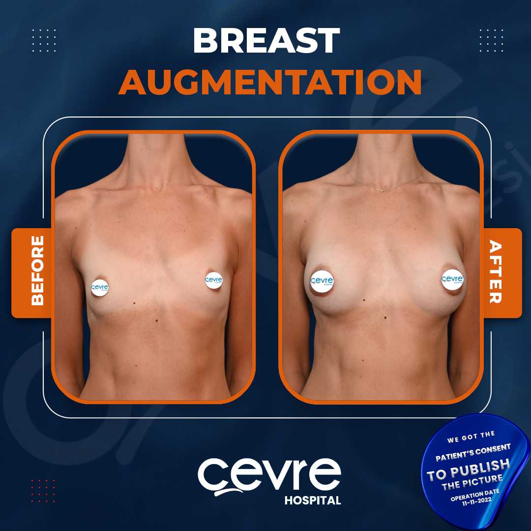 Breast Augmentation