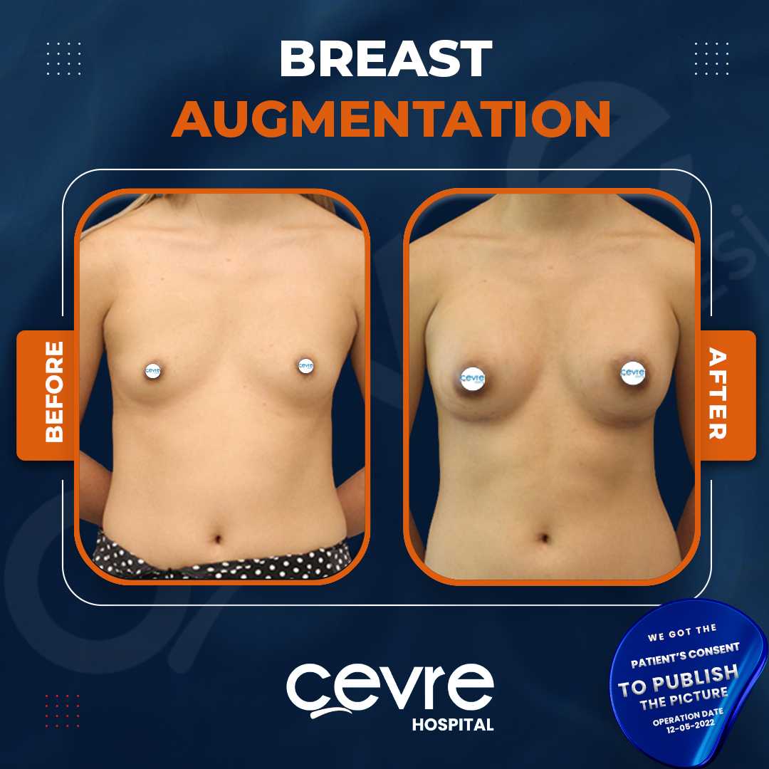 Breast Augmentation