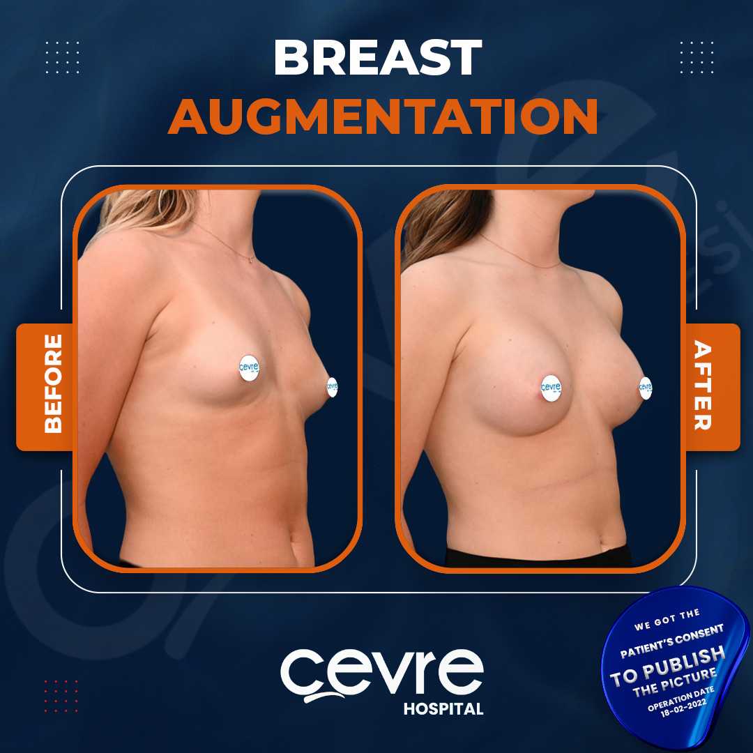 Breast Augmentation
