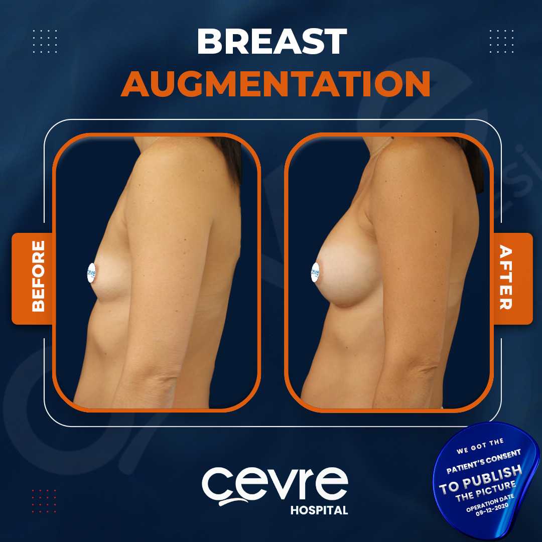 Breast Augmentation