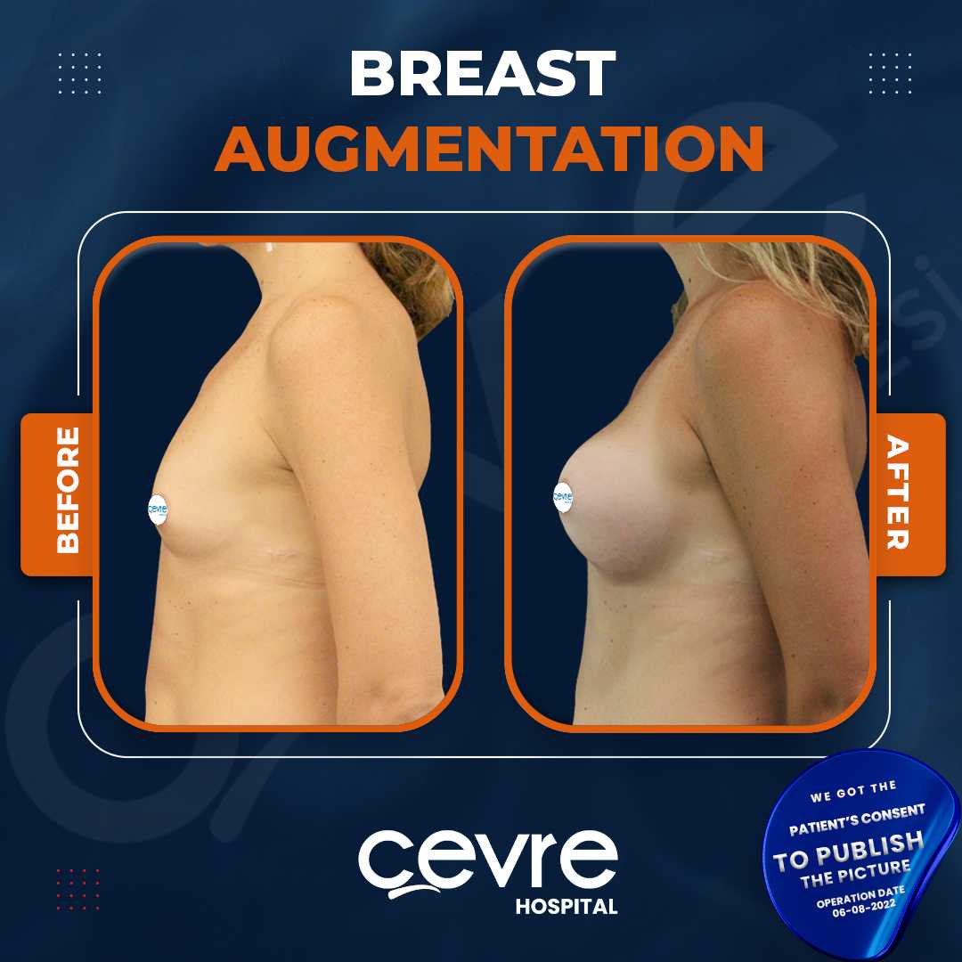 Breast Augmentation