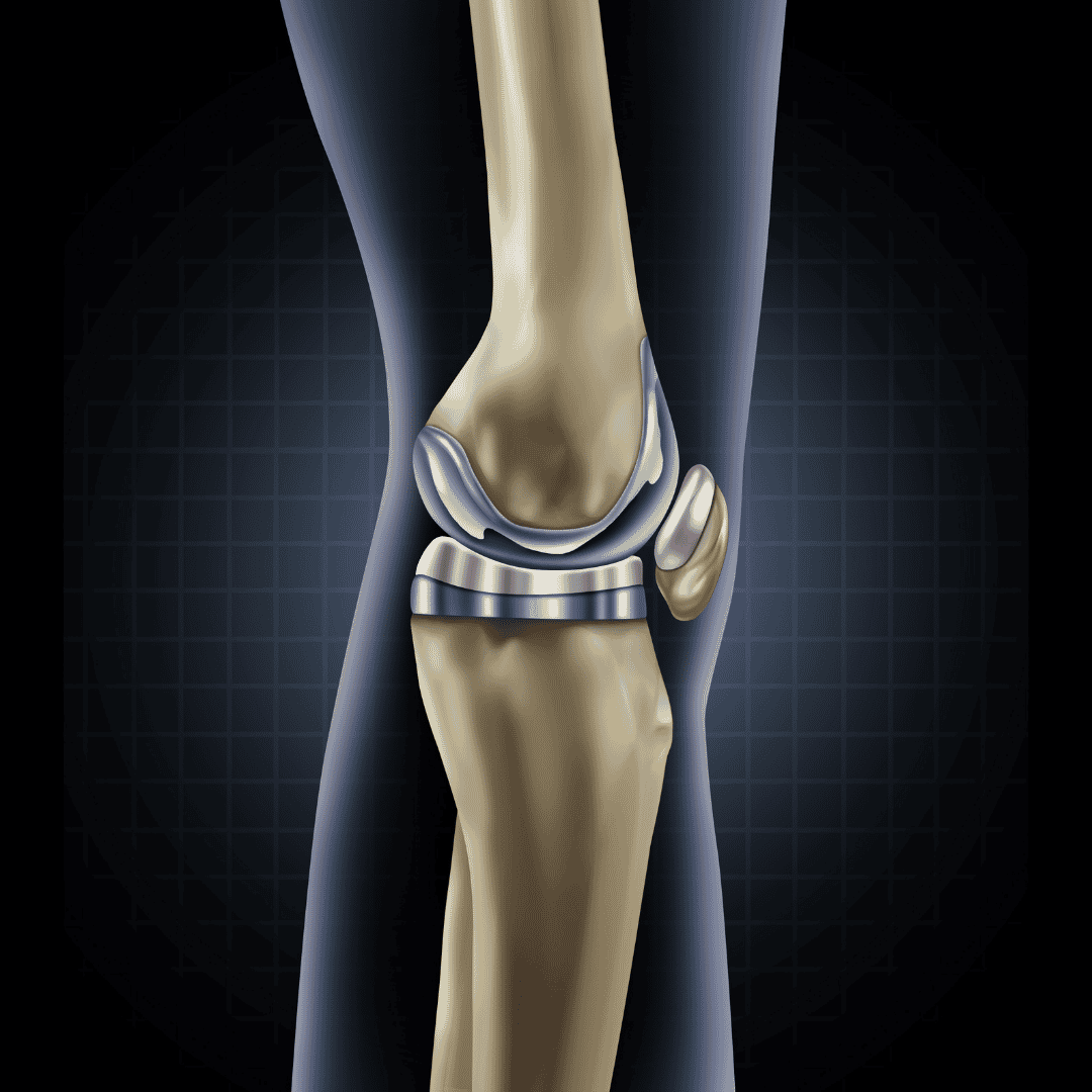 Knee Replacement in Turkey - Cost & Clinics