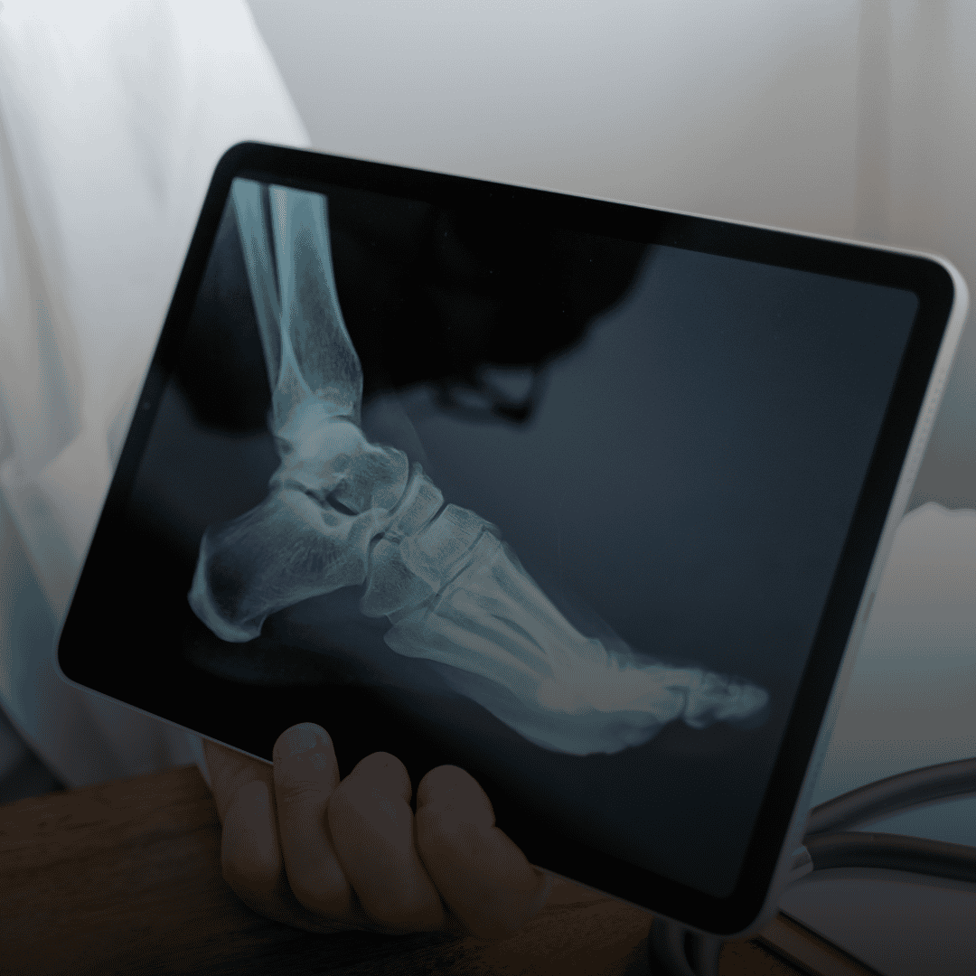 Orthopedic Surgery: Why Choose Cancun and Puerto Vallarta