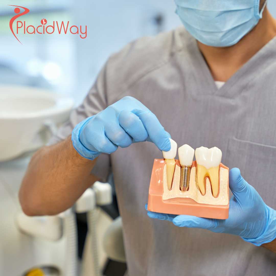 Affordable Dental Implants in Mexico: A Growing Trend Among Canadians