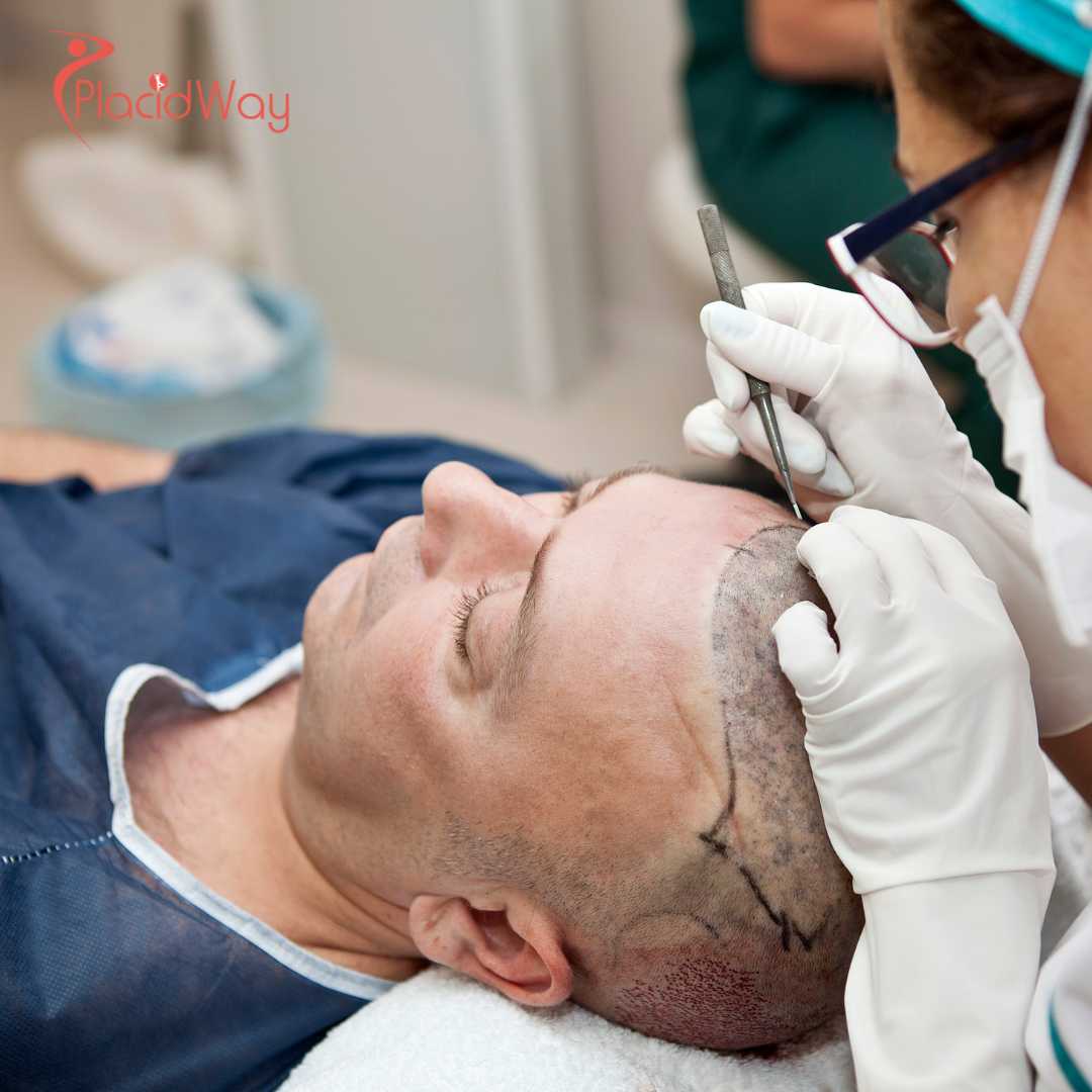 Hair Transplants in Turkey: Affordable Solutions for Canadians Seeking Hair Restoration