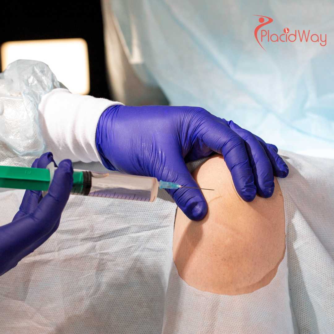 Stem Cell Therapy for Cartilage Regeneration in Mexico: A Cost-Effective Solution for Canadians