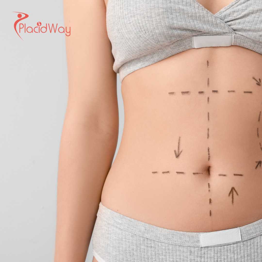 Liposuction in Turkey: Why Canadians are Choosing Turkey for Affordable Body Sculpting