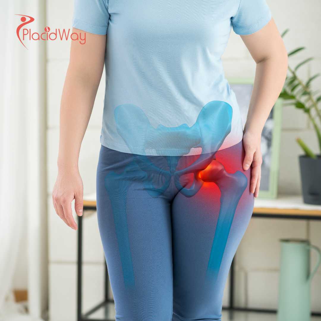 Hip Replacement Surgery in Turkey: Cost-Effective Orthopedic Care for Australian Tourists