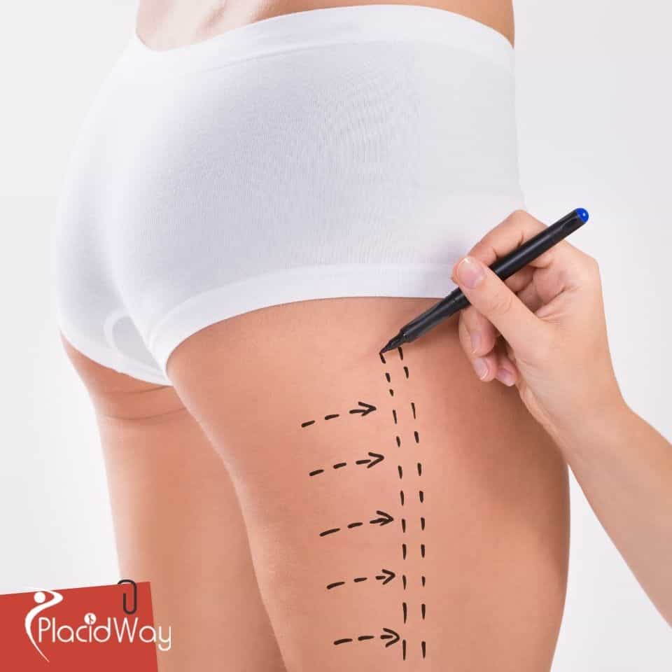 Liposuction in Colombia: Affordable Body Sculpting for Texas Patients