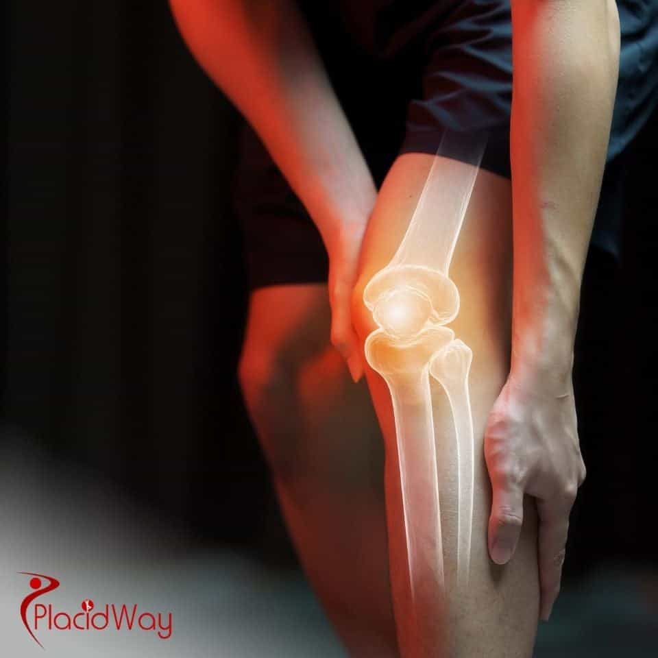 Stem Cell Therapy for Osteoarthritis in Colombia: Affordable Joint Pain Solutions for Illinois Patients