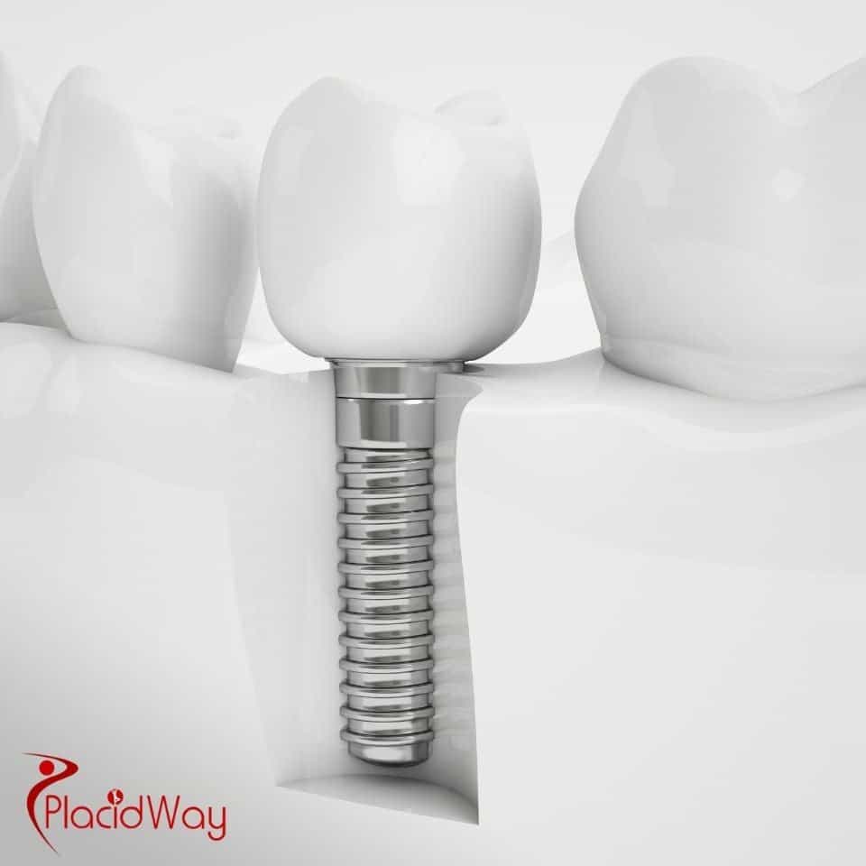 Dental Implants in Turkey: Why German Patients Choose All-on-4 Implants for a Full Smile Restoration