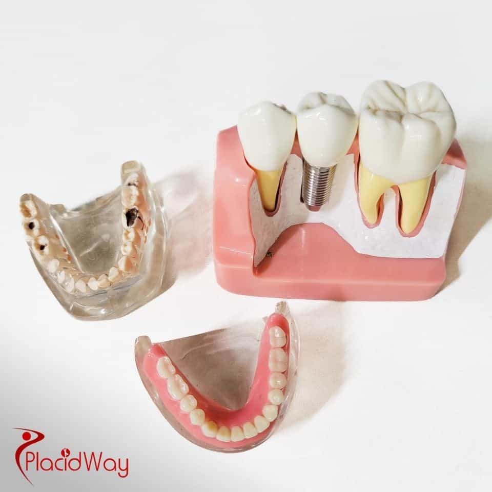 Dental Implants in Colombia: Affordable Solutions for Illinois Patients