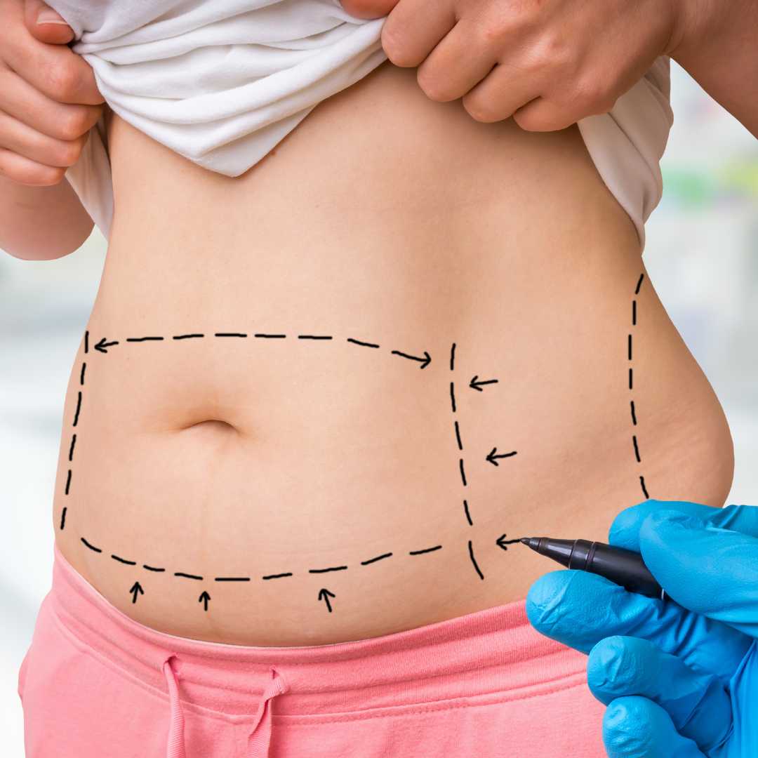 Liposuction from Vancouver to Tijuana, Mexico – Transform Your Look Abroad