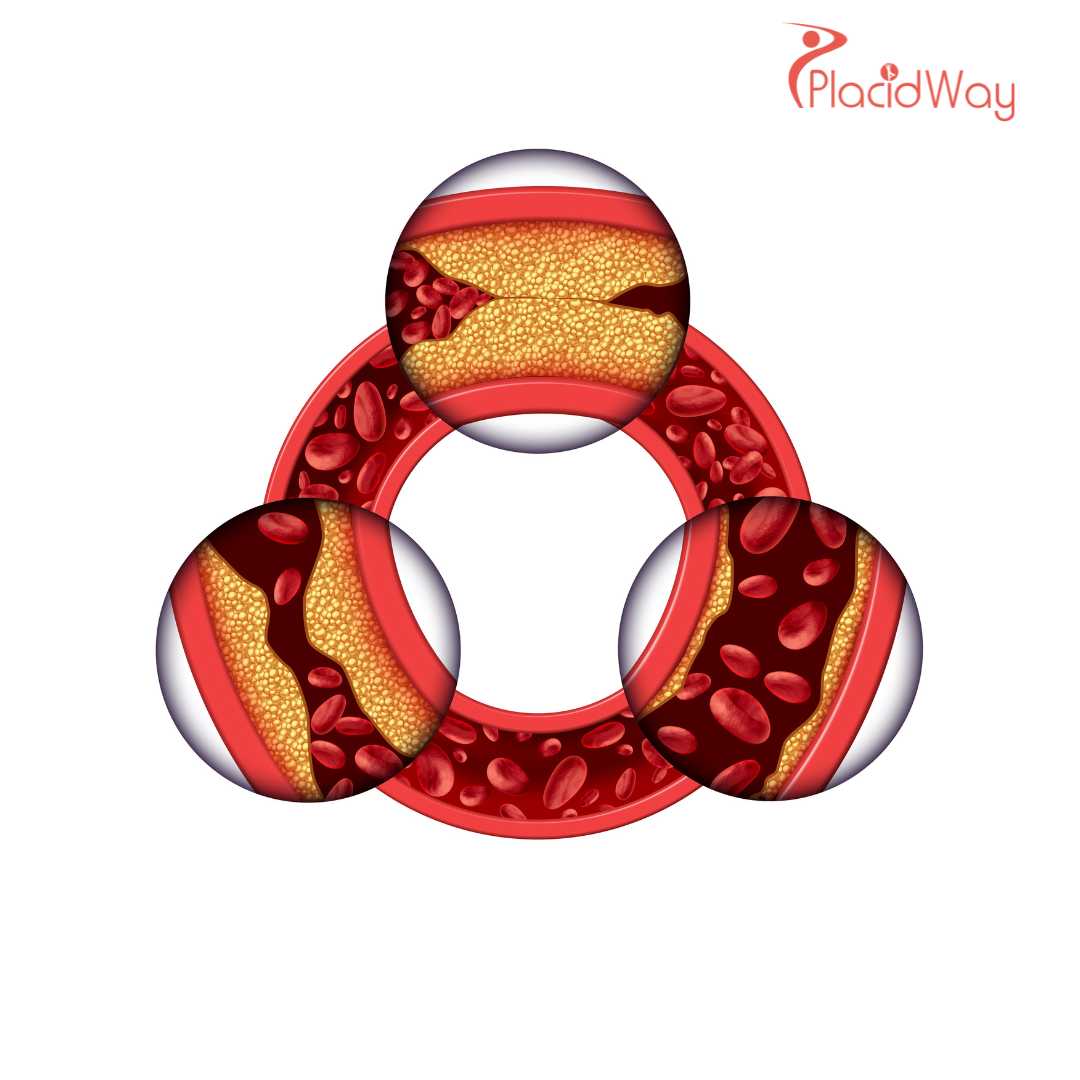 Arteriosclerosis Stem Cell Treatment Japan: The Future of Vascular Health