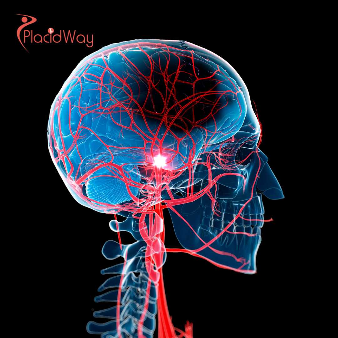 Stem Cell Therapy for Stroke in India: Costs, Success Rates & Recovery Guide