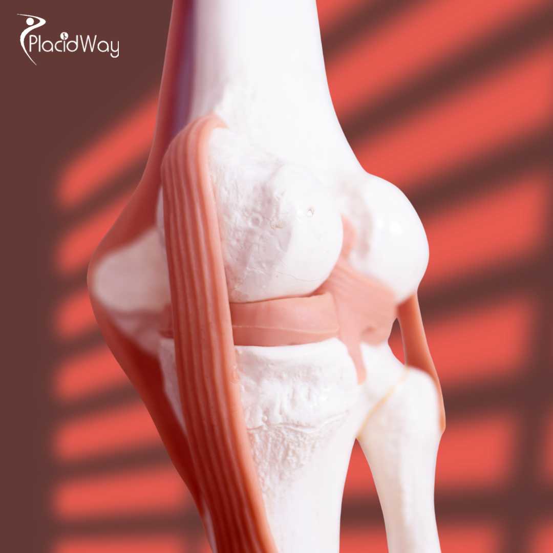 Meniscus Tear Stem Cell Therapy in Thailand Bringing Relief to Patients from Kuwait