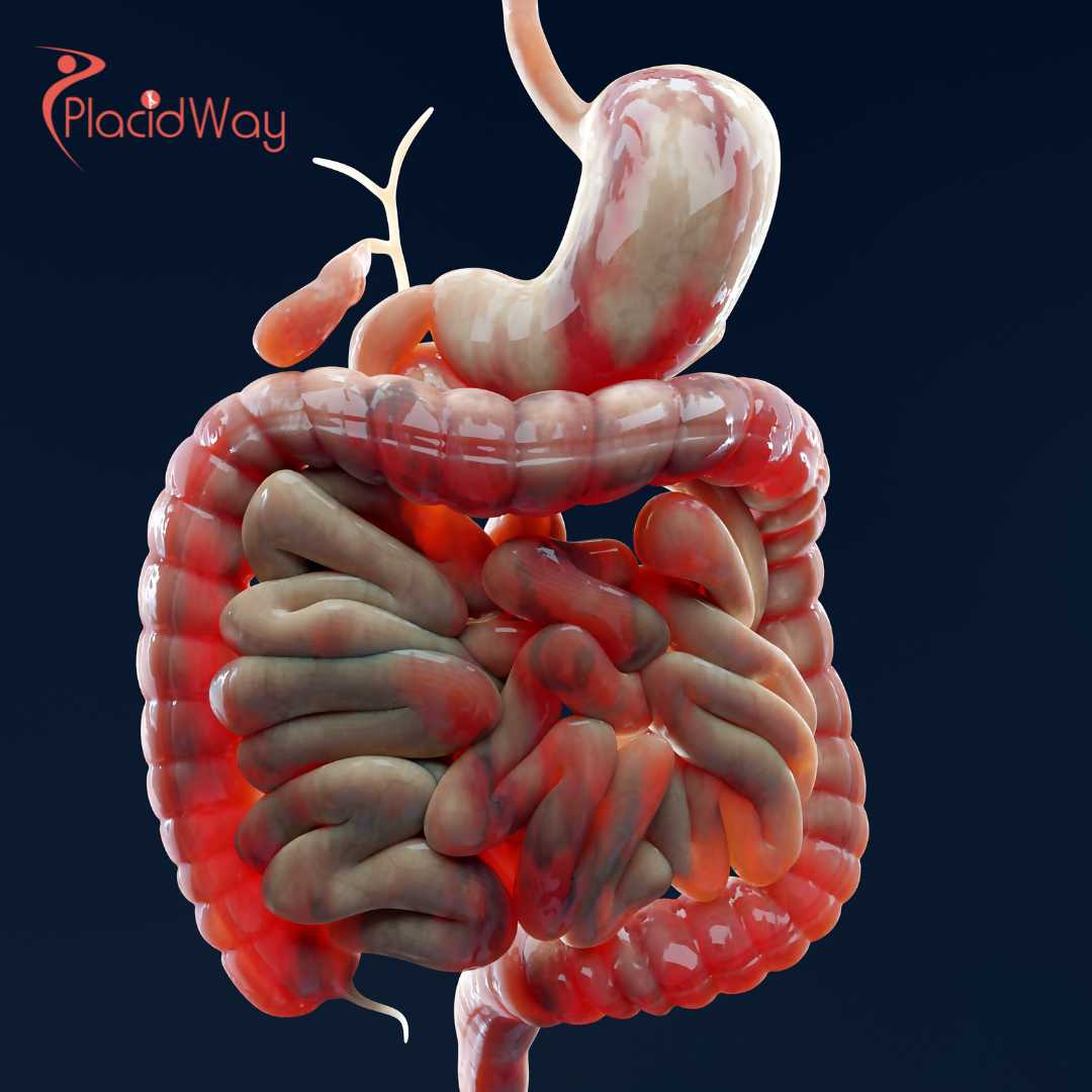Advanced Crohns Disease Stem Cell Therapy in Japan: A Complete Guide