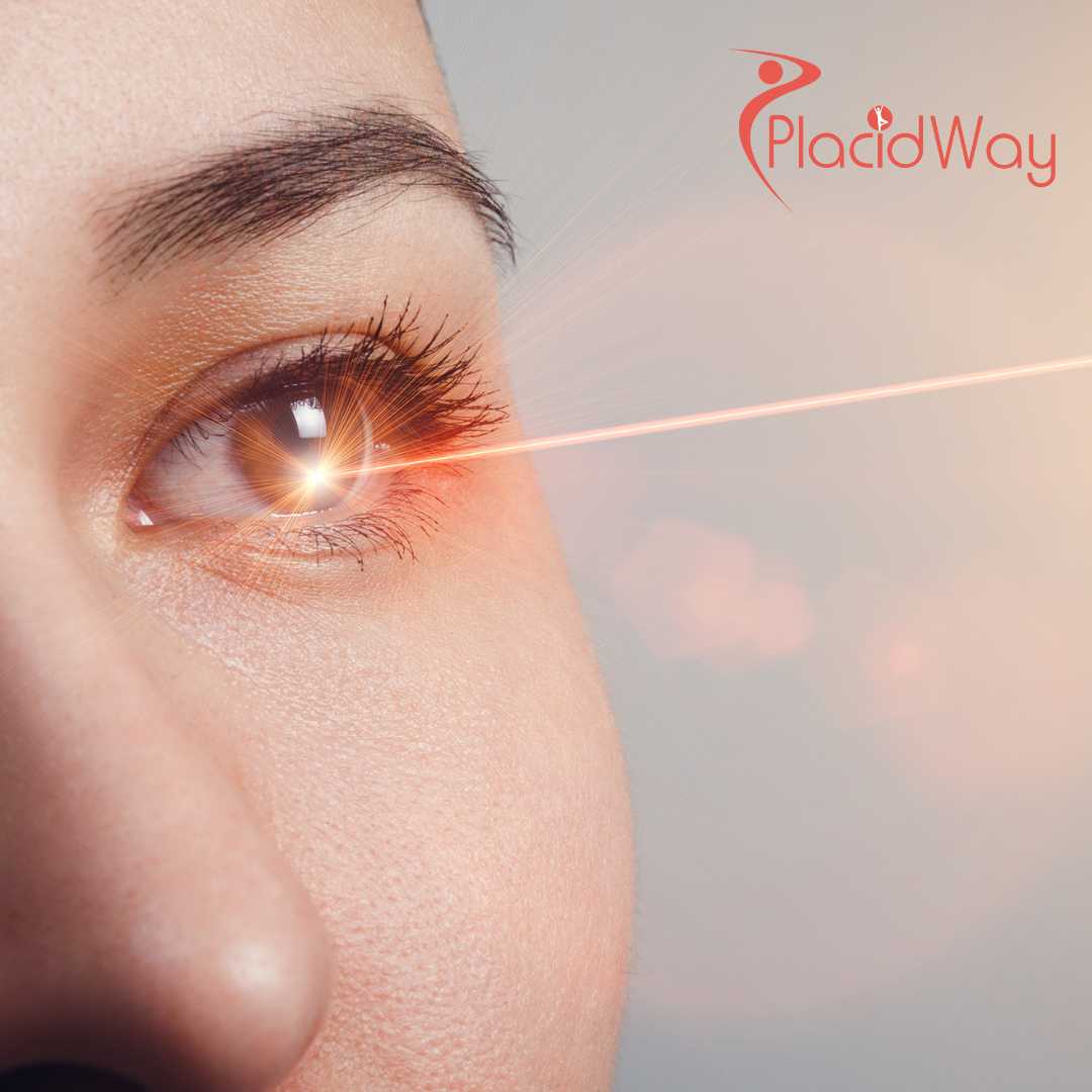 Laser Vision Correction in Turkey for Vancouver Patients