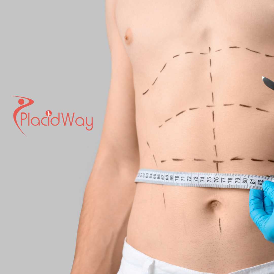 Abdominoplasty (Tummy Tuck) in Turkey for Stuttgart Patients Following Weight Loss