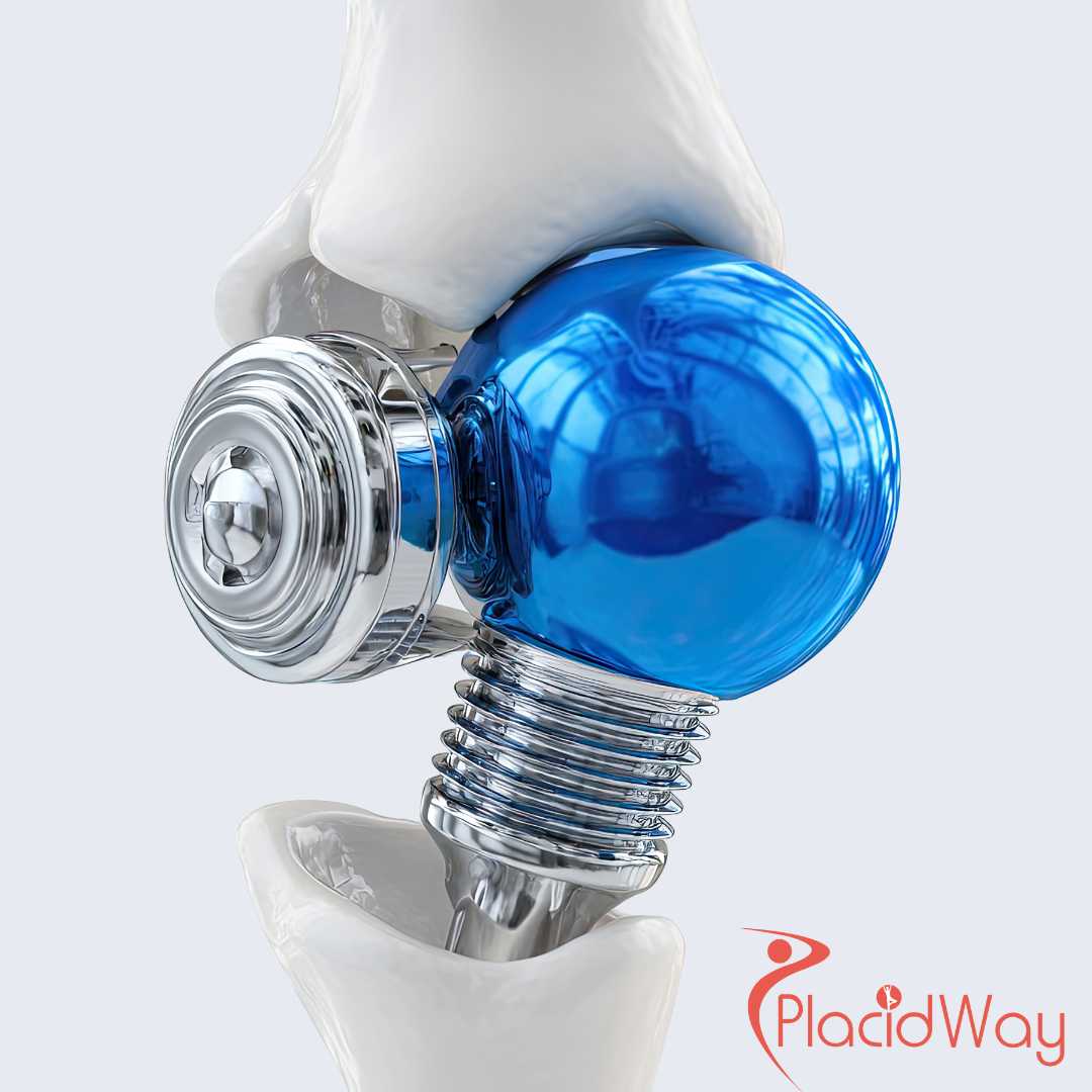 Knee Replacement Surgery in Turkey for Berlin Seniors