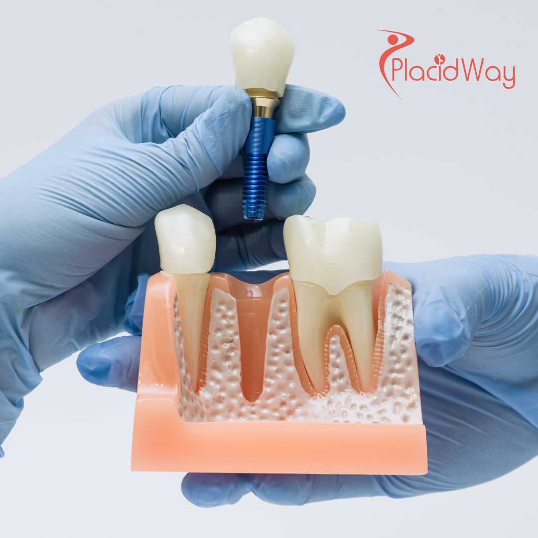 Full Mouth Restoration in Mexico for Edmonton Patients