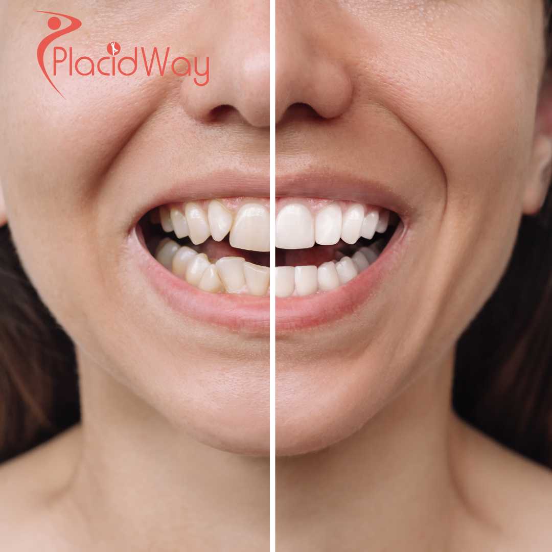 Porcelain Veneer Smile Design in Mexico for U.S. Patients