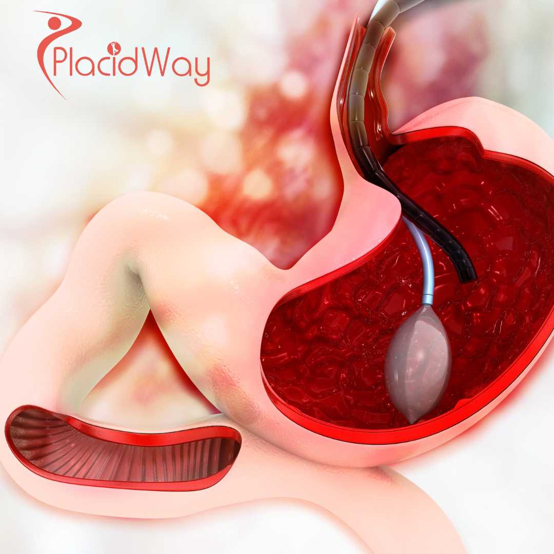 Non-Surgical Gastric Balloon Treatment in Mexico for U.S. Patients