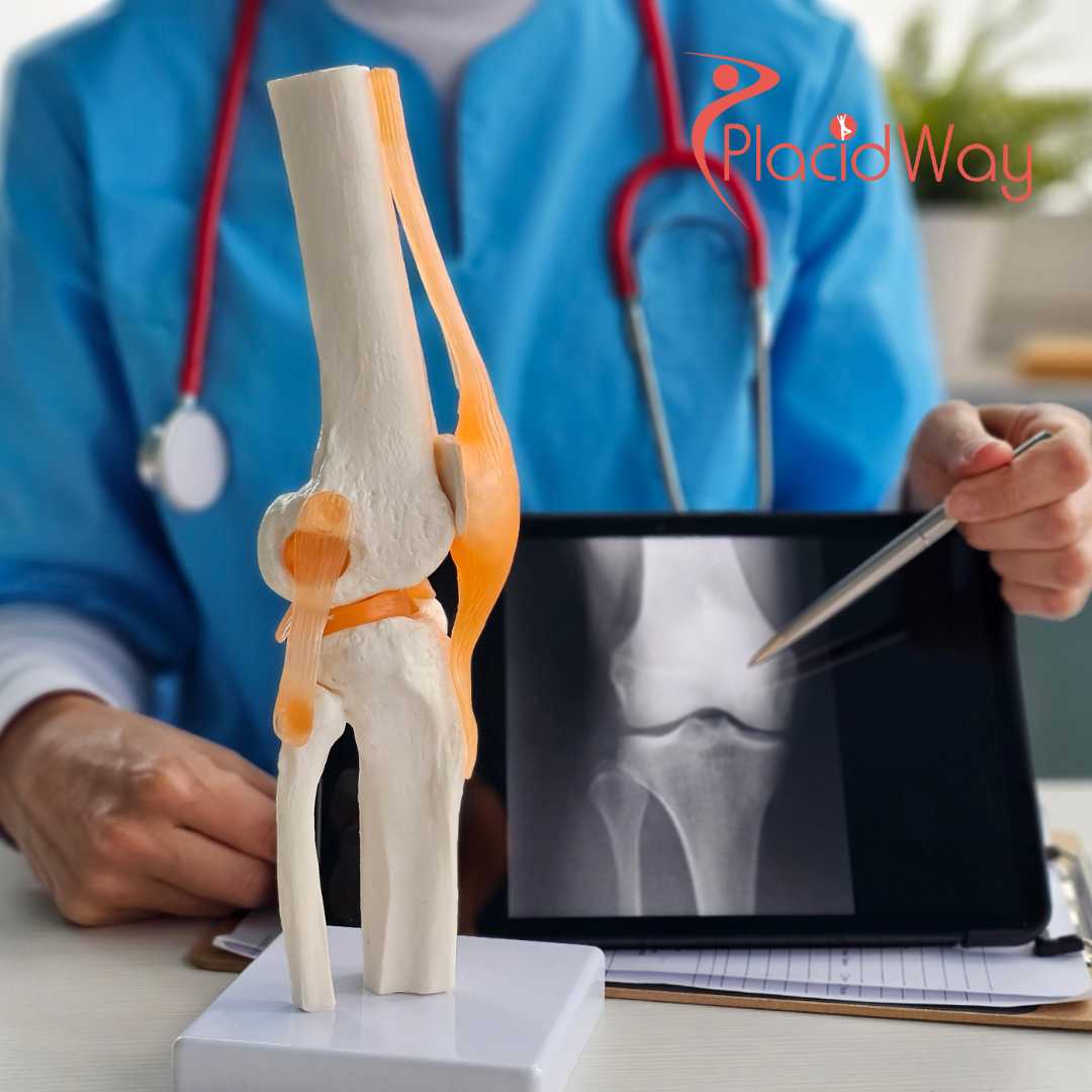 Knee Replacement Surgery in India for Bangladeshi Patients